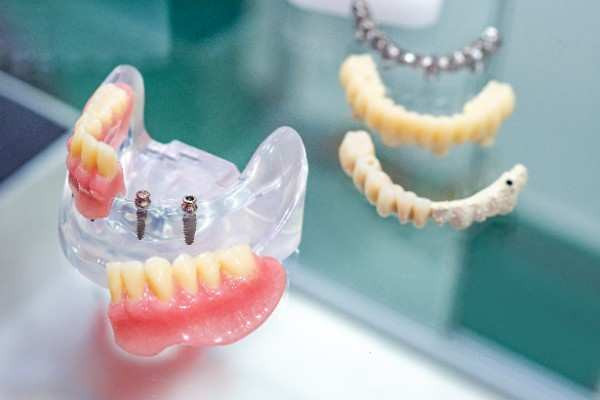dental implants Stirling