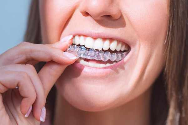 invisalign Stirling