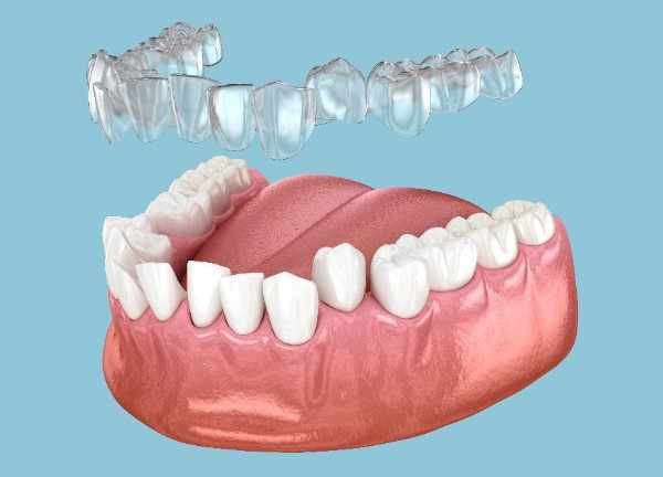 dental implants Corby