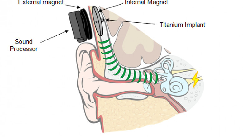Bone Conduction Implants: Why Future Headphones Might Be in Your Skull