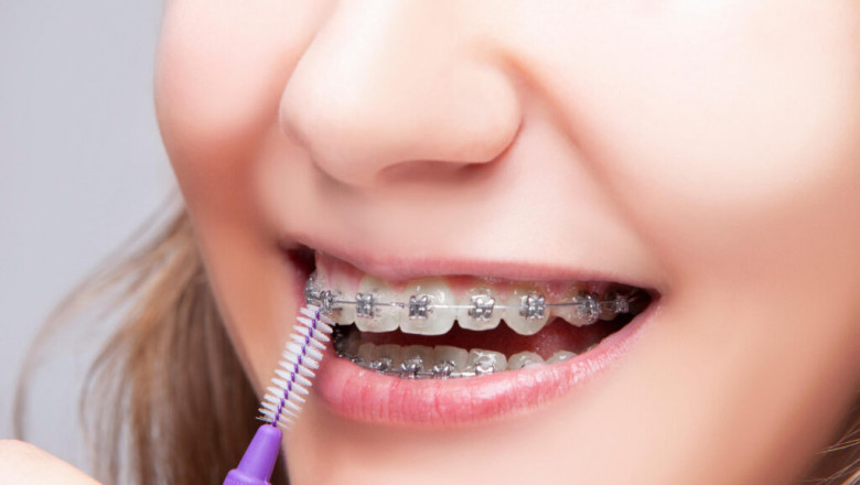 The Truth About Self-Ligating Braces: What Orthodontists Are Saying