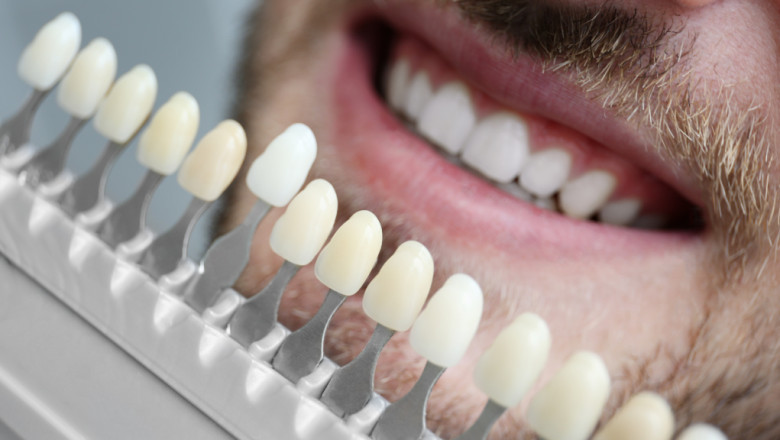 Why Non-Prep Veneers Are Popular Among Influencers and Celebrities