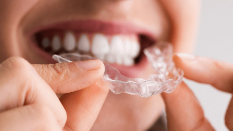 Can Night Guard Splints Improve Your Overall Oral Health?