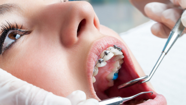 From Consultation to Completion: The Full Orthodontic Journey