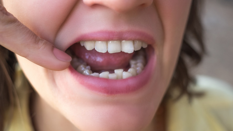 How Fixing Crooked Teeth Can Improve Your Overall Health