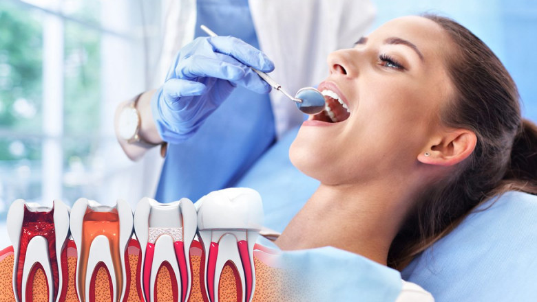 Laser Root Canal: A Painless Innovation or Hype?