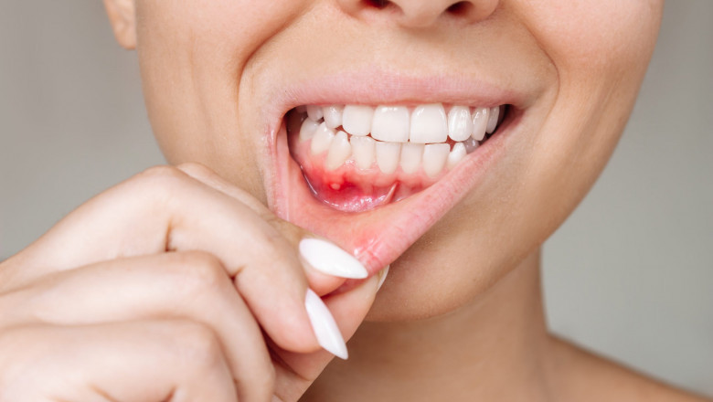 Looking for Gum Depigmentation? Here’s What to Ask Your Dentist