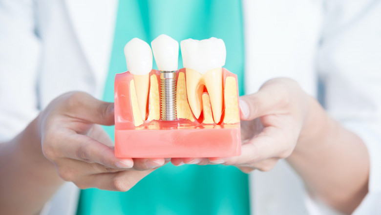 Same-Day Dental Implants for Patients with Gum Disease: Is It Possible?
