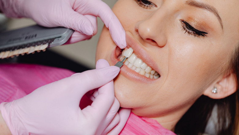 Dental Veneers vs. Teeth Whitening: Which Is Better for a Bright Smile?