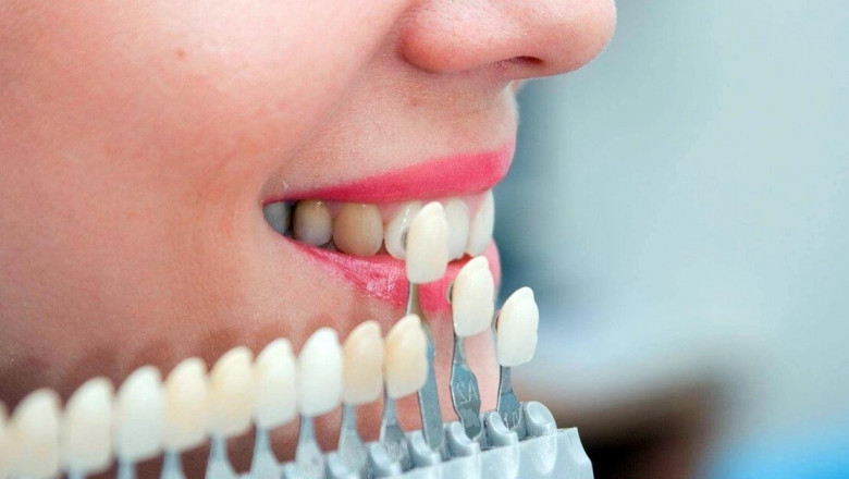 Decoding Dental Veneers: A Patient's Journey to a Flawless Grin
