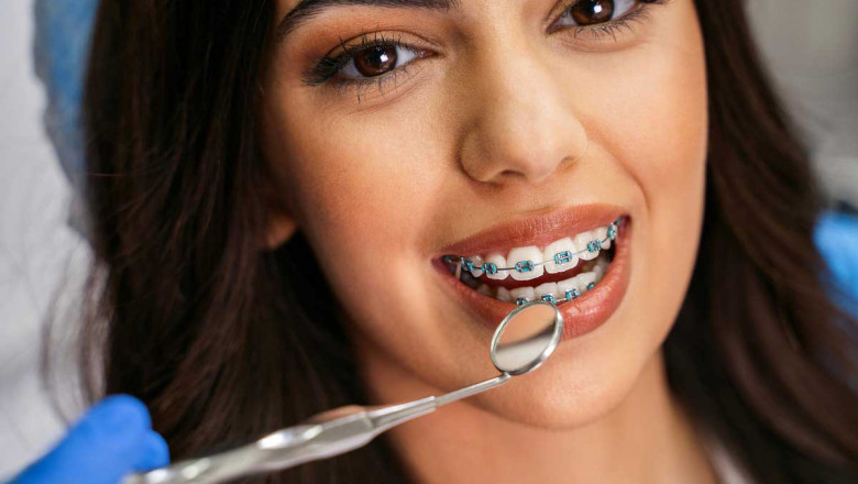 Common Myths About Dental Braces Debunked