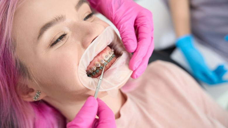 Keep Your Teeth White While Wearing Dental Braces