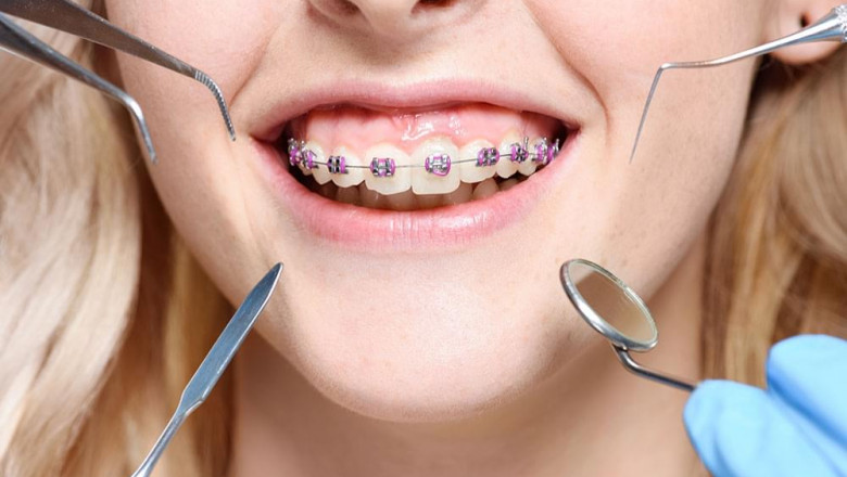 Orthodontist-Approved Tips for a Smooth Braces Journey
