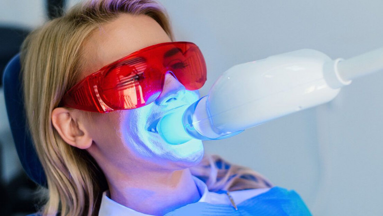 Can Zoom Whitening Remove Deep Stains? Find Out Here