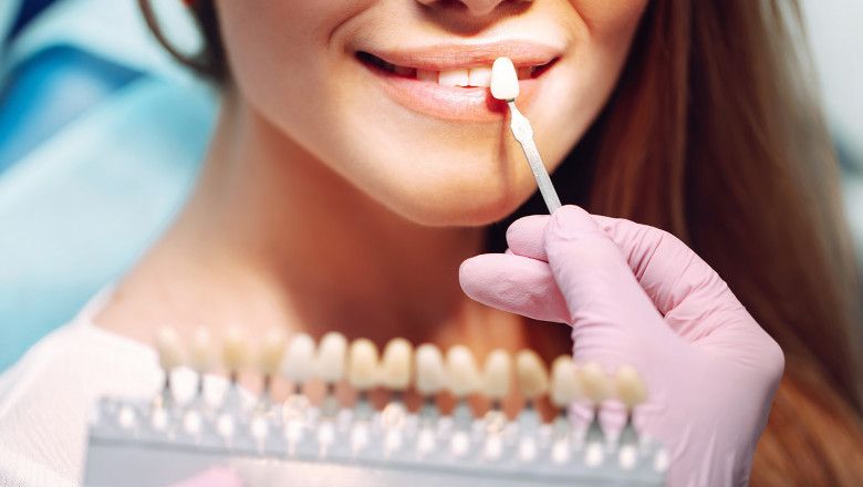 How Long Do E-max Veneers Last? A Comprehensive Overview